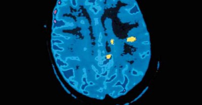 scan-cerveau