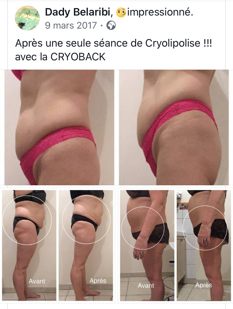 cryoback avant apres